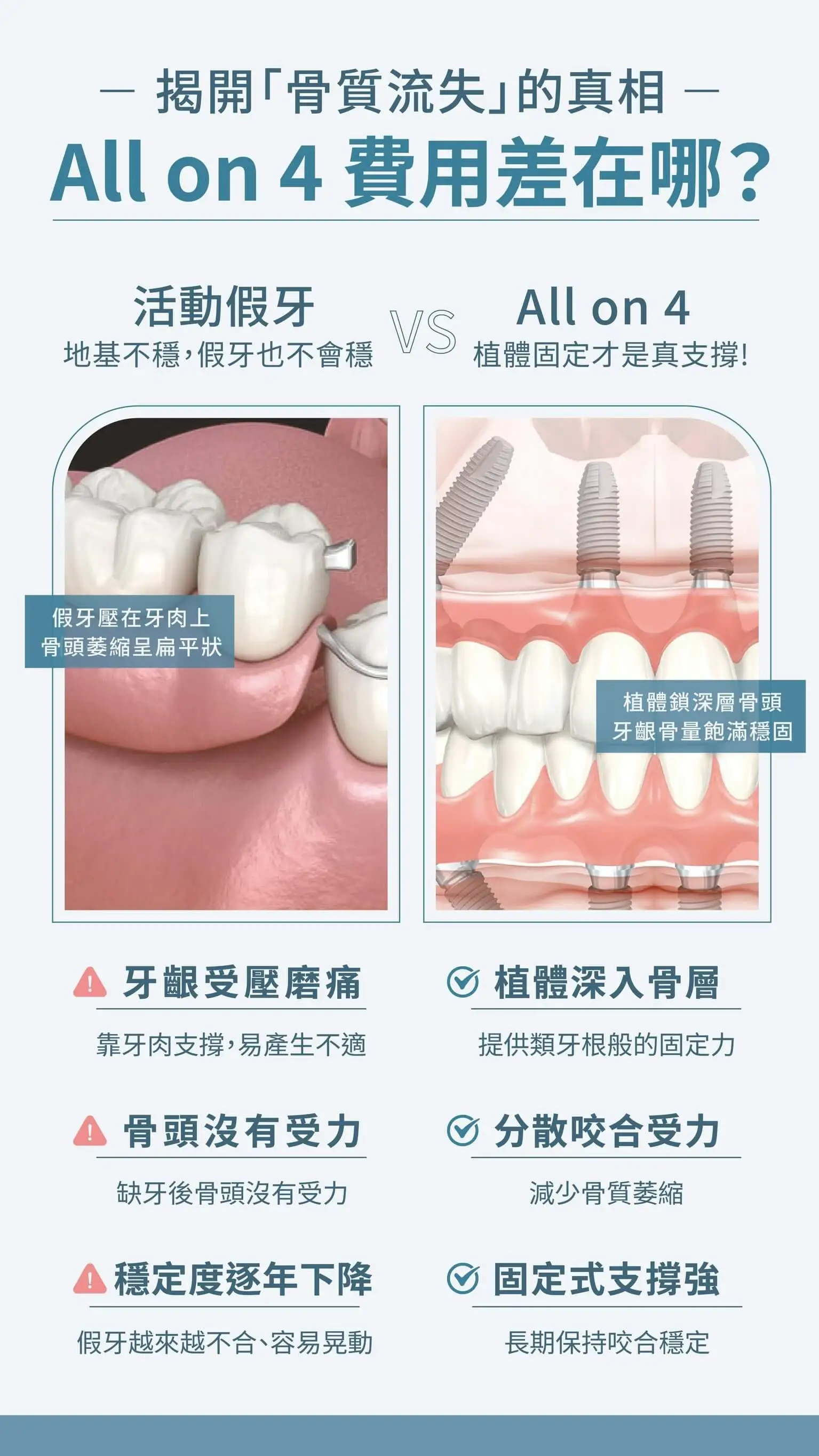 活動假牙與 All-on-4 植牙地基穩固度比較圖